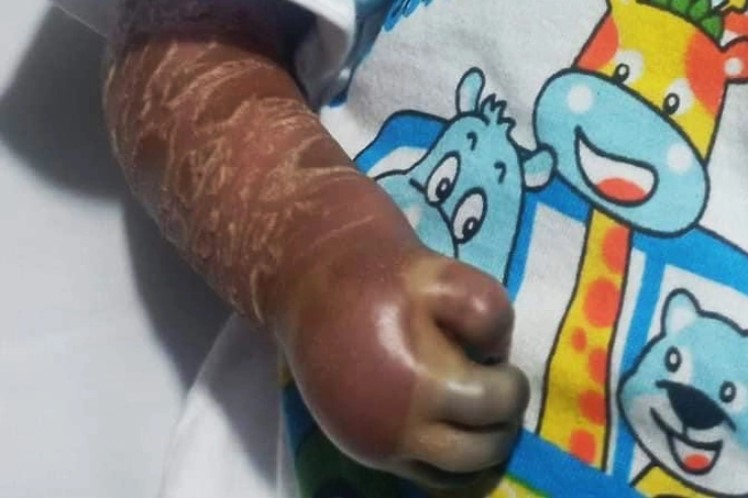 Bé trai ở Bình Thuận mới sinh đã mắc bệnh da vảy cá toàn thân